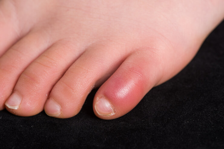 しもやけの症状を示す人の足の指の接写